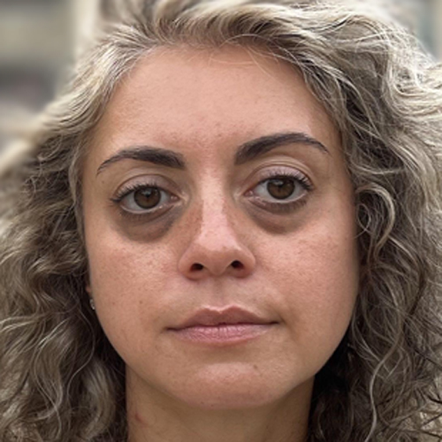 Sonia Ruiz Queens New York can be recognized by the prominent chronically swollen 'bags' beneath her eyes and often wears sunglasses to cover them up.